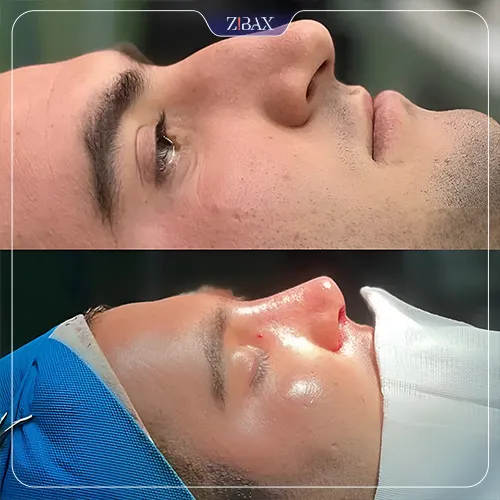 نمونه عمل جراحی بینی دکتر محمد بلاغی اینالویی — تصویر 5
