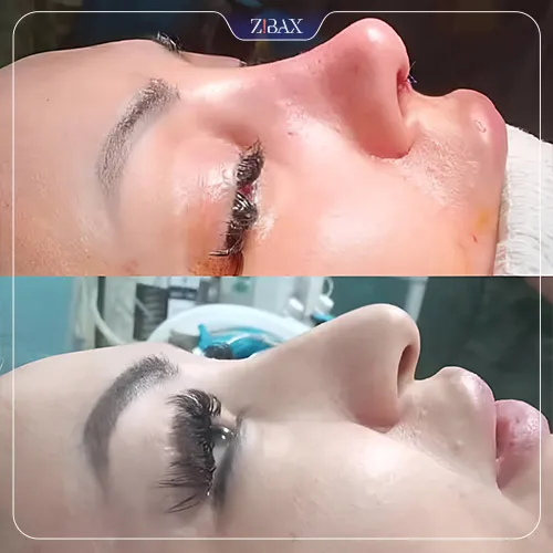 نمونه عمل جراحی بینی دکتر محمد بلاغی اینالویی — تصویر 6