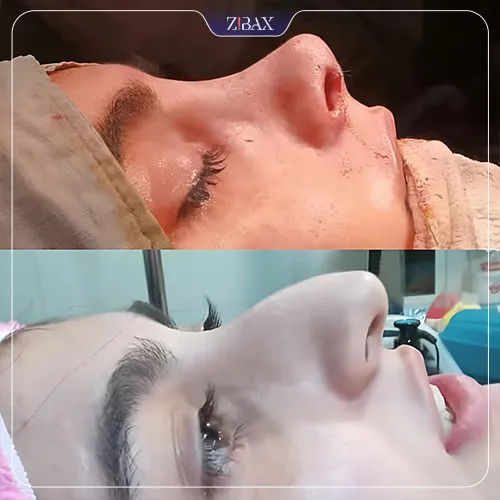 نمونه عمل جراحی بینی دکتر محمد بلاغی اینالویی — تصویر 7