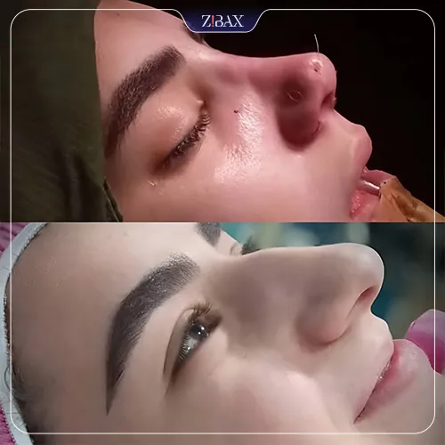 نمونه عمل جراحی بینی دکتر محمد بلاغی اینالویی — تصویر 8