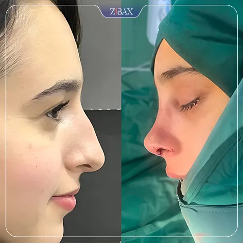 نمونه عمل جراحی بینی دکتر محمد بلاغی اینالویی — تصویر 10