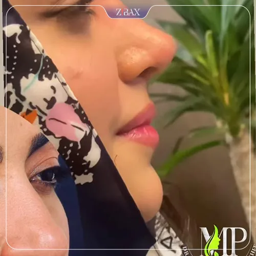 نمونه عمل جراحی بینی دکتر مهران پوربرفه‌ای — تصویر 1