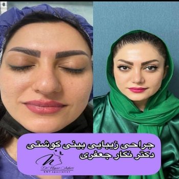 نمونه کار دکتر نگار جعفری جراح بینی در شیراز