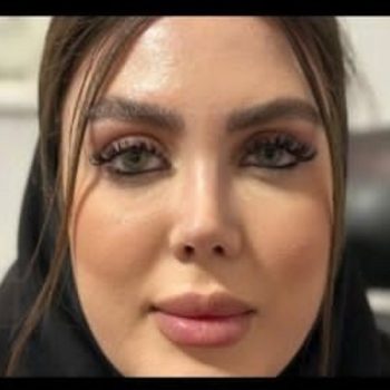 نمونه کار عمل بینی دکتر آرش سبحان منش با مجموعه زیباکس؛ جراح بینی در شیراز