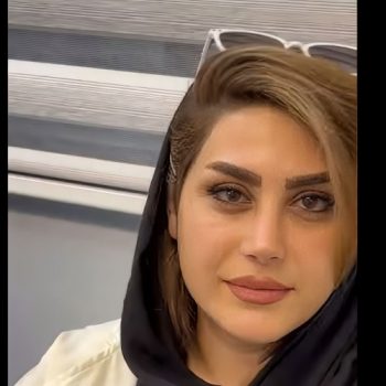 نمونه عمل بینی دکتر حامد پوستچی با مجموعه زیباکس؛ جراح بینی در شیراز