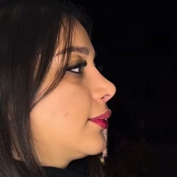 نمونه عمل بینی دکتر حمیدرضا کاظمی با مجموعه زیباکس؛ جراح بینی در شیراز