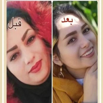 نمونه عمل زیبایی بینی با دکتر لیلا اسدپور در شیراز