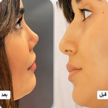 نمونه کار عمل بینی با دکتر لیلا اسدپور در شیراز
