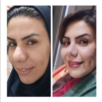 نمونه جراحی زیبایی بینی با دکتر غلامرضا معین در شیراز