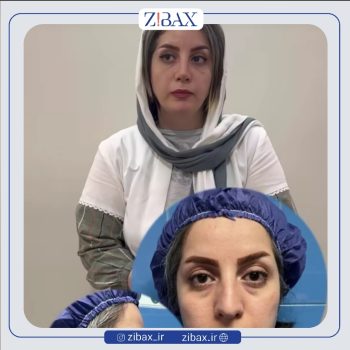نمونه جراحی بینی دکتر خسرو مقتدر جراح بینی در تهران