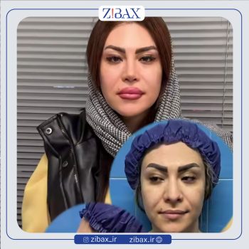 نمونه جراحی بینی دکتر خسرو مقتدر جراح بینی در تهران