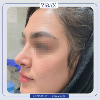 نمونه عمل دکتر جانی پور جراح بینی در شیراز