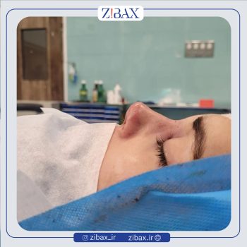 نمونه عمل دکتر شمیلا رضوانی نیا جراح بینی در شیراز