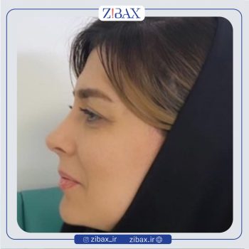 نمونه جراحی بینی دکتر نیما برادران جراح بینی در تهران
