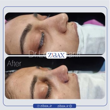 نمونه عمل بینی دکتر لیلا شریفی جراح بینی در شیراز