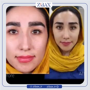 نمونه عمل بینی دکتر لیلا شریفی جراح بینی در شیراز