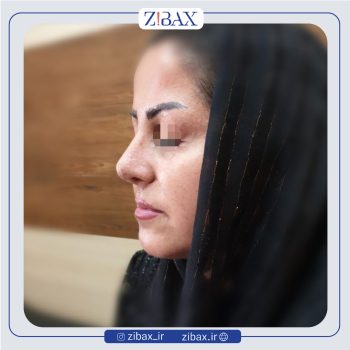 نمونه کار دکتر طیبه کاظمی جراح بینی در شیراز