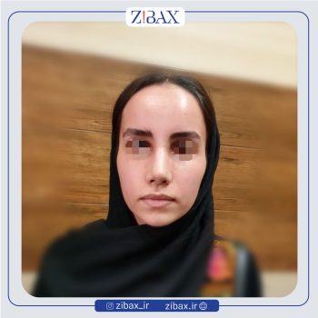 نمونه کار دکتر طیبه کاظمی جراح بینی در شیراز