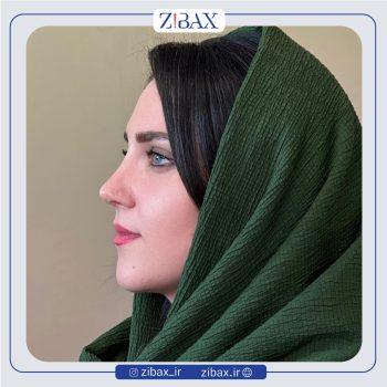 نمونه عمل بینی دکتر لیلا ملکی جراح بینی تهران