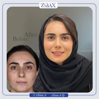 نمونه عمل بینی دکتر محمد طالب زاده جراح بینی در رشت