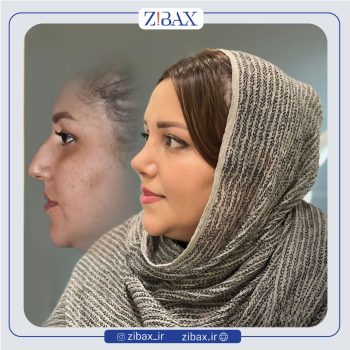 نمونه عمل بینی دکتر محمد طالب زاده جراح بینی در رشت