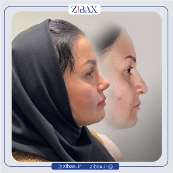 نمونه عمل بینی دکتر محمد طالب زاده جراح بینی در رشت