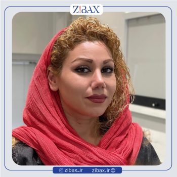 نمونه عمل بینی دکتر محمد طالب زاده جراح بینی در رشت