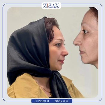 نمونه عمل بینی دکتر محمد طالب زاده جراح بینی در رشت