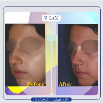 نمونه عمل بینی دکتر بیژن ربیعی جراح بینی در شیراز