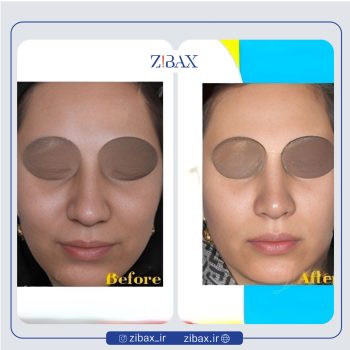 نمونه عمل بینی دکتر بیژن ربیعی جراح بینی در شیراز