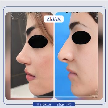 نمونه عمل بینی دکتر الهام کابلی جراح بینی در تهران