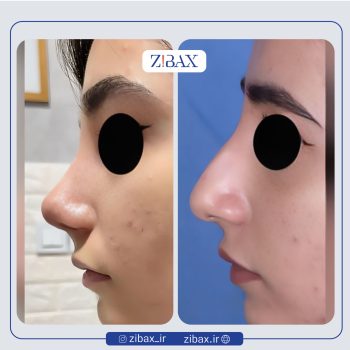 نمونه عمل بینی دکتر الهام کابلی جراح بینی در تهران