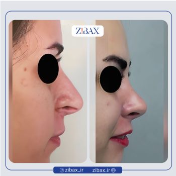 نمونه عمل بینی دکتر الهام کابلی جراح بینی در تهران