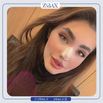 نمونه عمل بینی دکتر الهام کابلی جراح بینی در تهران