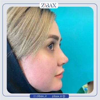 نمونه عمل بینی دکتر صفا صمدزاده در تهران