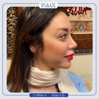 نمونه عمل بینی دکتر صفا صمدزاده در تهران
