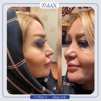 نمونه عمل بینی دکتر صفا صمدزاده در تهران