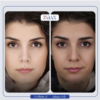 نمونه عمل بینی دکتر پارسا چراغی پور جراح بینی در تهران