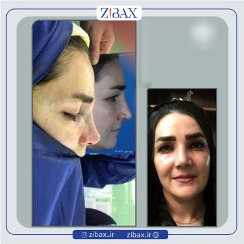 نمونه عمل بینی دکتر سارا رودگری در تهران