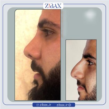 نمونه عمل بینی دکتر سارا رودگری در تهران