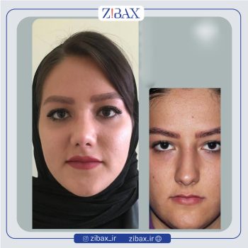 نمونه عمل بینی دکتر سارا رودگری در تهران
