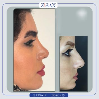 نمونه عمل بینی دکتر سارا رودگری در تهران