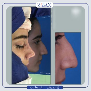 نمونه عمل بینی دکتر سارا رودگری در تهران