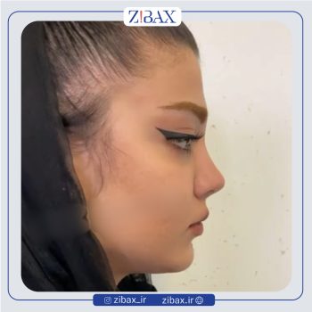 تصویر عمل زیبایی بینی با دکتر علیرضا توکلی در تهران