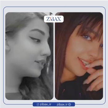 نمونه جراحی بینی با دکتر علیرضا توکلی در تهران