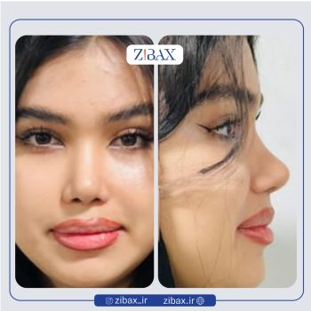 نمونه جراحی زیبایی بینی با دکتر علیرضا توکلی جراح بینی تهران