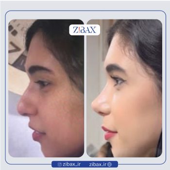 نمونه کار عمل زیبایی بینی دکتر علیرضا توکلی در تهران