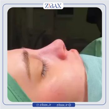 نمونه عمل بینی دکتر حامد محمدی جراح بینی تهران