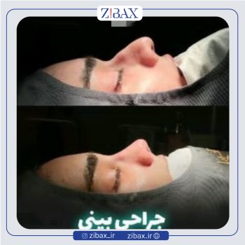 نمونه عمل بینی دکتر حامد محمدی جراح بینی تهران