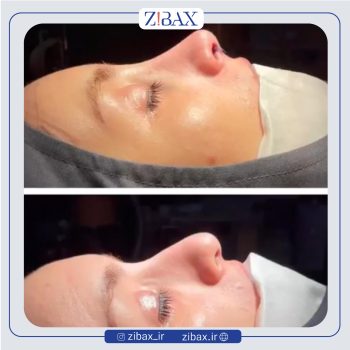نمونه عمل بینی دکتر حامد محمدی جراح بینی تهران